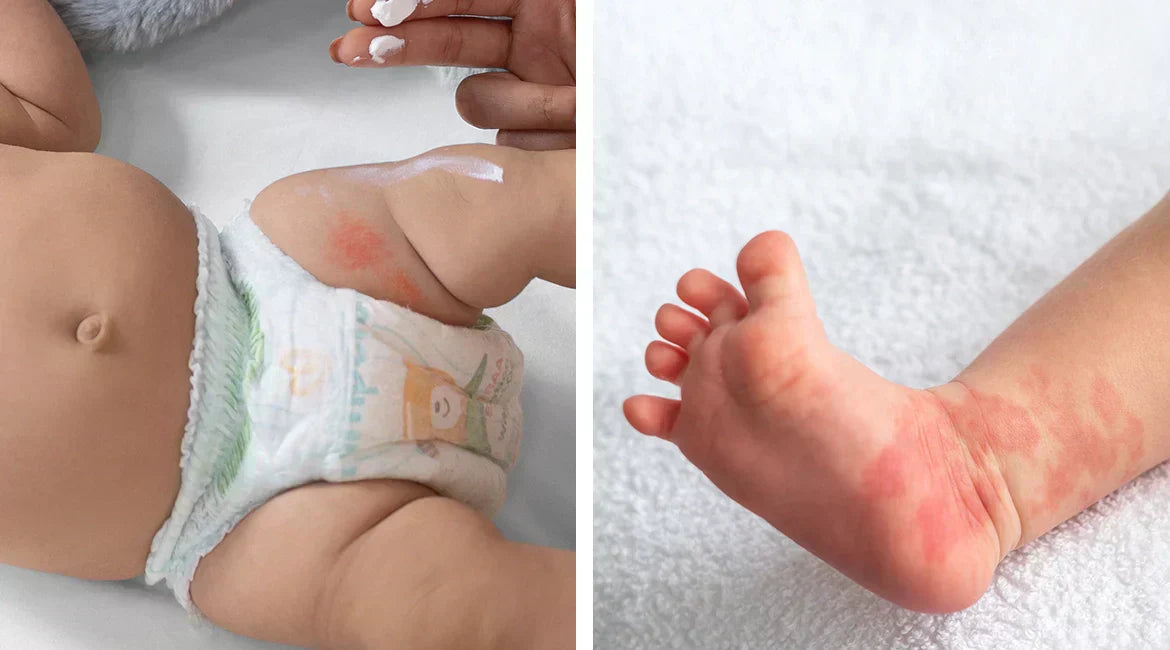 Diaper Rash vs Heat Rash: Key Differences
